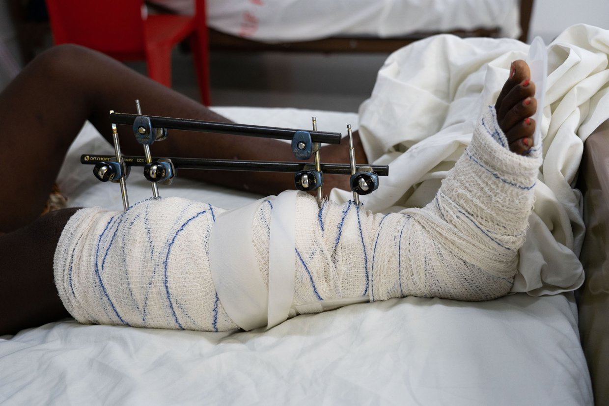 Gipsat ben med skruvar