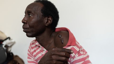 En man visar upp ett ärr på sin axel.