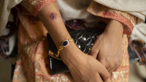 Närbild på en arm med ett sår ungefär lika stort som en 5-krona.