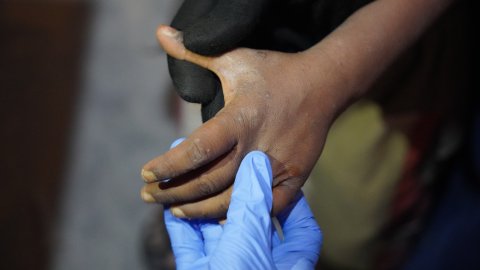 En hand med handske håller i en hand med skabb.