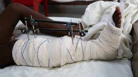 Gipsat ben med skruvar