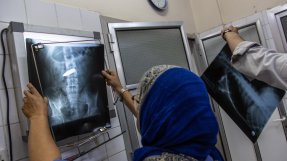 En kvinna kollar på en röntgenplåt som visar en stor kula på insidan