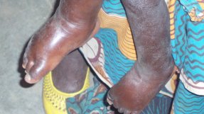 Kwashiorkor är en form av undernäring som uppstår när kroppen saknar protein, och orsakar bland annat svullnad.