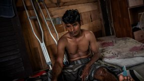 En ung rohingyaflykting i Malysia som skadat sitt ben i arbetet