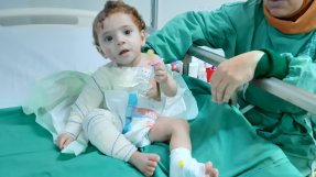 Sju månader gamla Amina med omfattande brännskador på sjukhuset i Qayyarah