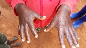 Två barnhänder med tydliga ärr efter sjukdomen skabb.
