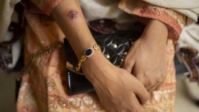 Närbild på en arm med ett sår ungefär lika stort som en 5-krona.