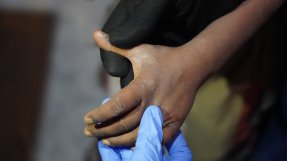 En hand med handske håller i en hand med skabb.