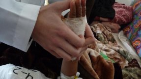 En sjukgymnasr stretchar handen på en patient som blivit brännskadad efter en gasexplosion. Behandling på Al-Salam-sjukhuset tidigare i år – nu har vi tvingats avbryta vårt arbete där.