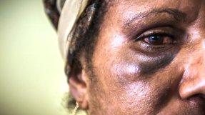 En av våra patienter på familjestödcentret i Port Moresby. FOTO: Yann Libessart