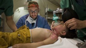 En flicka från Gaza med svåra brännskador får kirurgisk vård. 