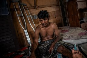 En ung rohingyaflykting i Malysia som skadat sitt ben i arbetet