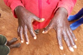 Två barnhänder med tydliga ärr efter sjukdomen skabb.