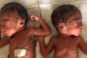 Tvillingar som föddes i i staden Mamfe i sydvästra Kamerun.