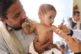 En 10 månader gammal flicka blir undersökt på Läkare Utan Gränsers undernäringsklinik i Taiz, Jemen.