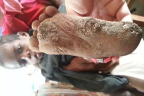 Bara och unga fötter är känsliga för sandflugornas bett. Flugorna lägger sin ägg  i huden vilket orsakar skador på vävnaden. 