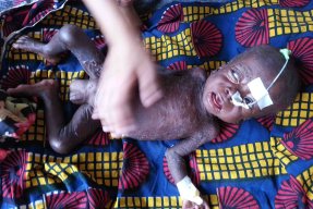 Malaria, mässling och malnutrition (undernäring) är tre mycket vanliga sjukdomar hos barn i Katanga, Kongo-Kinshasa. 