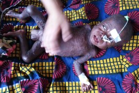 Malaria, mässling och malnutrition (undernäring) är tre mycket vanliga sjukdomar hos barn i Katanga, Kongo-Kinshasa. 