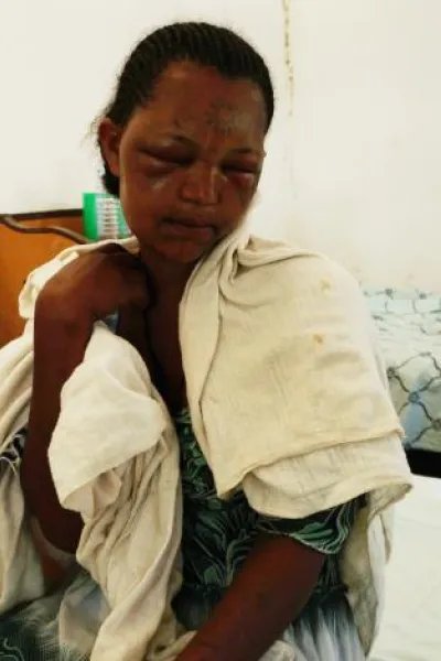 Workey Mekonen, 24 år, blev ormbiten när hon sov i Kafta, Tigray, Etiopen.