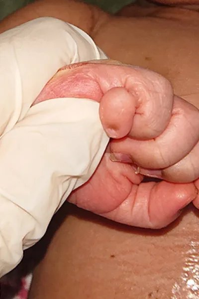 En hand i en läkarhandske som håller i ett litet barns hand