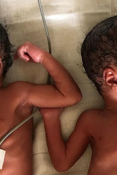 Tvillingar som föddes i i staden Mamfe i sydvästra Kamerun.