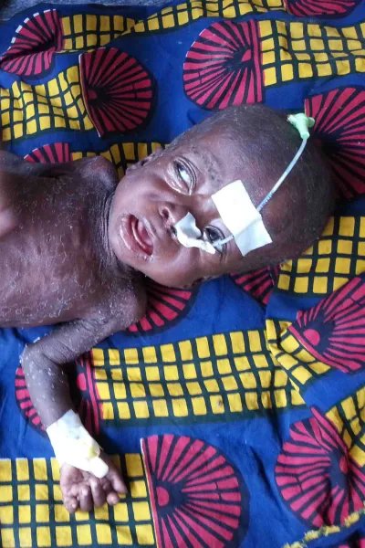 Malaria, mässling och malnutrition (undernäring) är tre mycket vanliga sjukdomar hos barn i Katanga, Kongo-Kinshasa. 