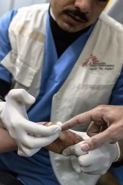 En brännskadad patient får såren omlagda på Läkare Utan Gränsers postoperativa klinik i Gaza. På grund av de täta bombningarna är det svårt för patienter och hjälparbetare att förflytta sig i Gaza. FOTO: Chris Huby