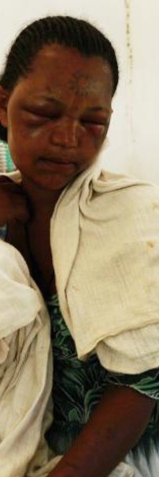 Workey Mekonen, 24 år, blev ormbiten när hon sov i Kafta, Tigray, Etiopen.