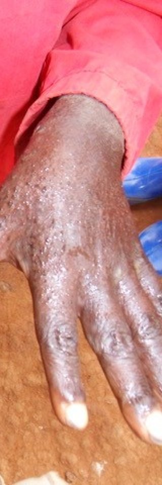 Två barnhänder med tydliga ärr efter sjukdomen skabb.