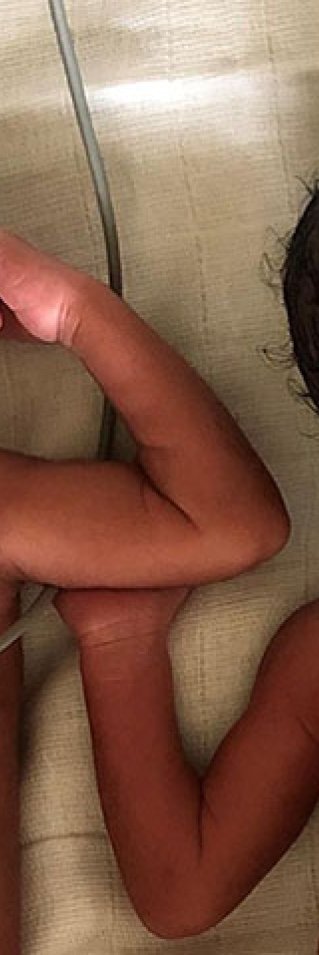 Tvillingar som föddes i i staden Mamfe i sydvästra Kamerun.