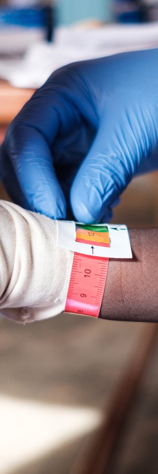 Personal mäter överarmens omkrets med en så kallad MUAC (mid-upper arm circumference) på ett undernärt barn.