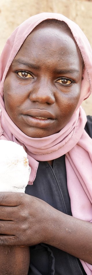 Kvinna håller upp sin amputerade hand.