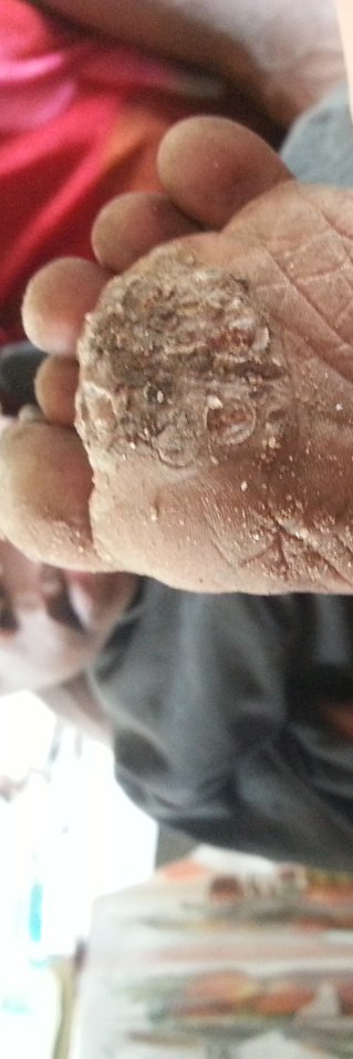 Bara och unga fötter är känsliga för sandflugornas bett. Flugorna lägger sin ägg  i huden vilket orsakar skador på vävnaden. 