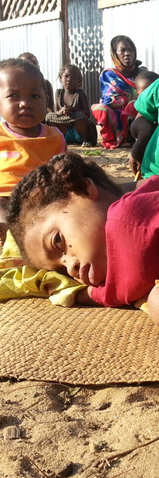 Det finns många typer av medfödda sjukdomar och missbildningar, som ofta beror på undernäring. I denna familj har alla fem barn skador på skelettet.