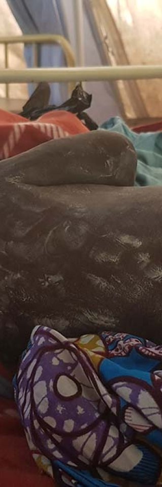 En pojke med mässling får lindring i form av en klådstillande lotion.