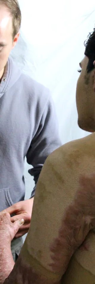 Arkitektstuderanden Nadir, 20, skadades när en gasbehållare exploderade under Gazakriget sommaren 2014. De svåra brännskadorna kräver kirurgisk vård på Läkare Utan Gränsers klinik i Gaza för att förbättra hans rörelseförmåga. 