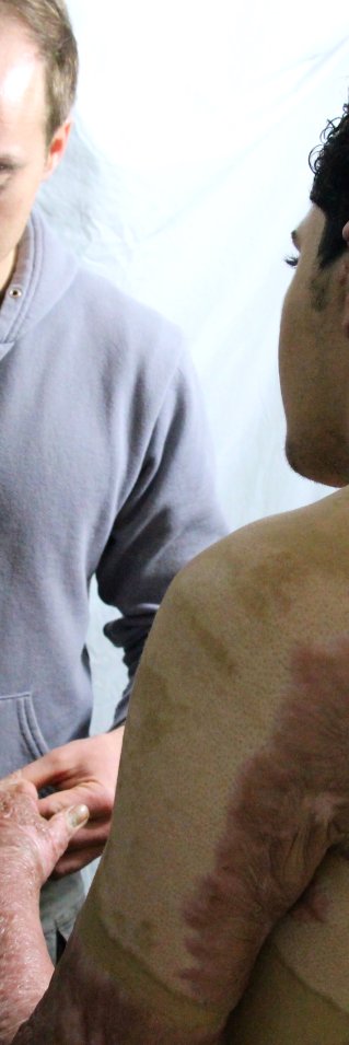 Arkitektstuderanden Nadir, 20, skadades när en gasbehållare exploderade under Gazakriget sommaren 2014. De svåra brännskadorna kräver kirurgisk vård på Läkare Utan Gränsers klinik i Gaza för att förbättra hans rörelseförmåga. 