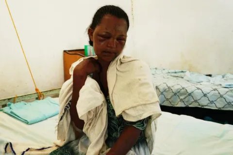 Workey Mekonen, 24 år, blev ormbiten när hon sov i Kafta, Tigray, Etiopen.