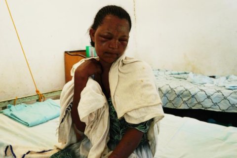 Workey Mekonen, 24 år, blev ormbiten när hon sov i Kafta, Tigray, Etiopen.