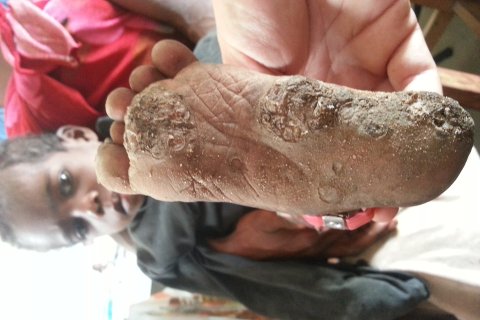 Bara och unga fötter är känsliga för sandflugornas bett. Flugorna lägger sin ägg  i huden vilket orsakar skador på vävnaden. 