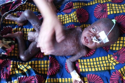 Malaria, mässling och malnutrition (undernäring) är tre mycket vanliga sjukdomar hos barn i Katanga, Kongo-Kinshasa. 