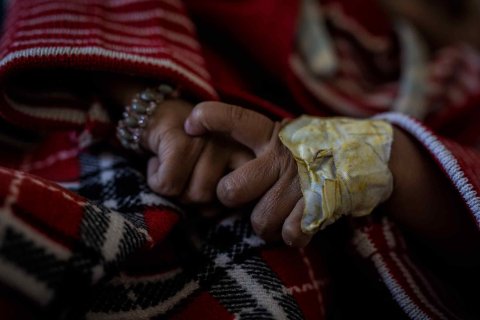 Flickan Sumaya är undernärd. Hon togs omhand på sjukhuset i Khamir, Jemen.