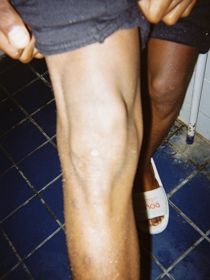 Ett knä och ett ben med ärr.