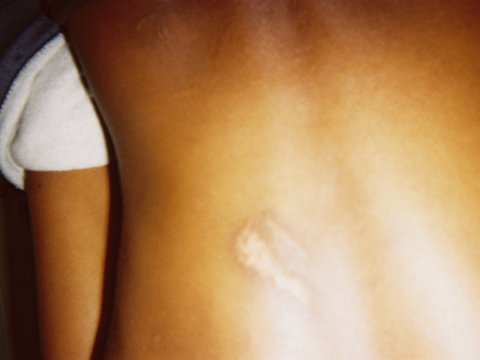 Foto på en rygg med ett ärr.